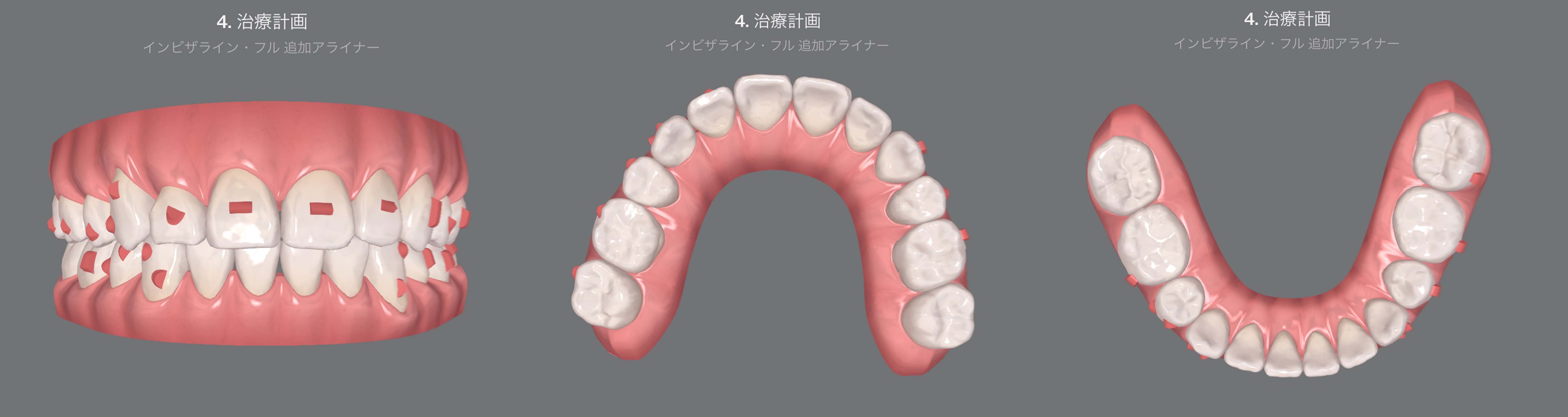 矯正治療のメリット